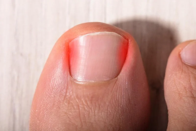 Nếu đã xử lý tại nhà nhưng tình trạng không cải thieeji, vui lòng đến cơ sở y khoa thăm khám để được xử lý kịp thời