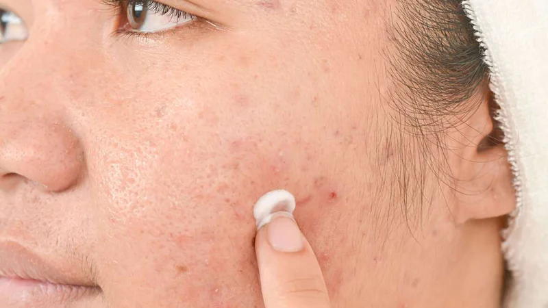 Cách sử dụng sản phẩm chứa Clindamycin an toàn và hiệu quả