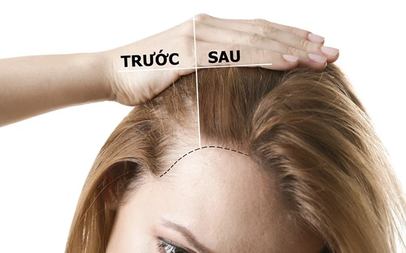 Tìm hiểu lợi ích để biết có nên tẩy da chết cho da đầu không