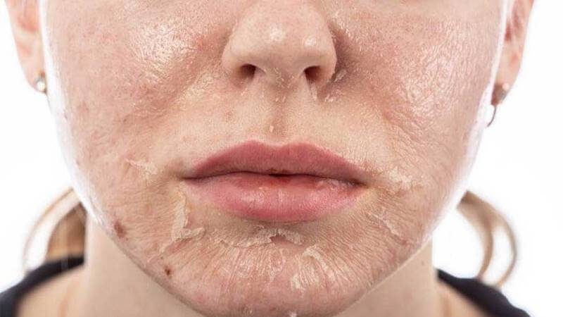 Sử dụng thuốc bắc tái tạo da tại nhà có thể là một giải pháp tiện lợi và tiết kiệm chi phí. Tuy nhiên, để đạt hiệu quả tối ưu và đảm bảo an toàn, bạn cần tuân thủ một số nguyên tắc sau: