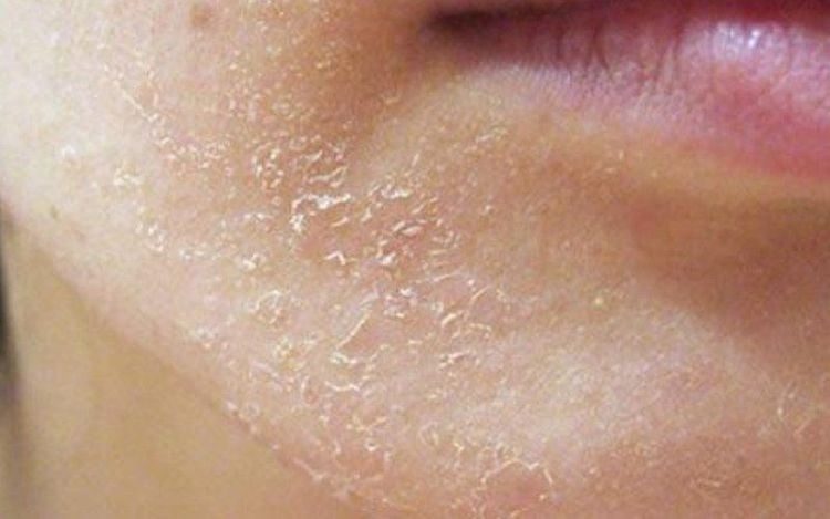 Có nên xài thuốc bắc tái tạo da? Công dụng của thuốc bắc trong việc tái tạo da