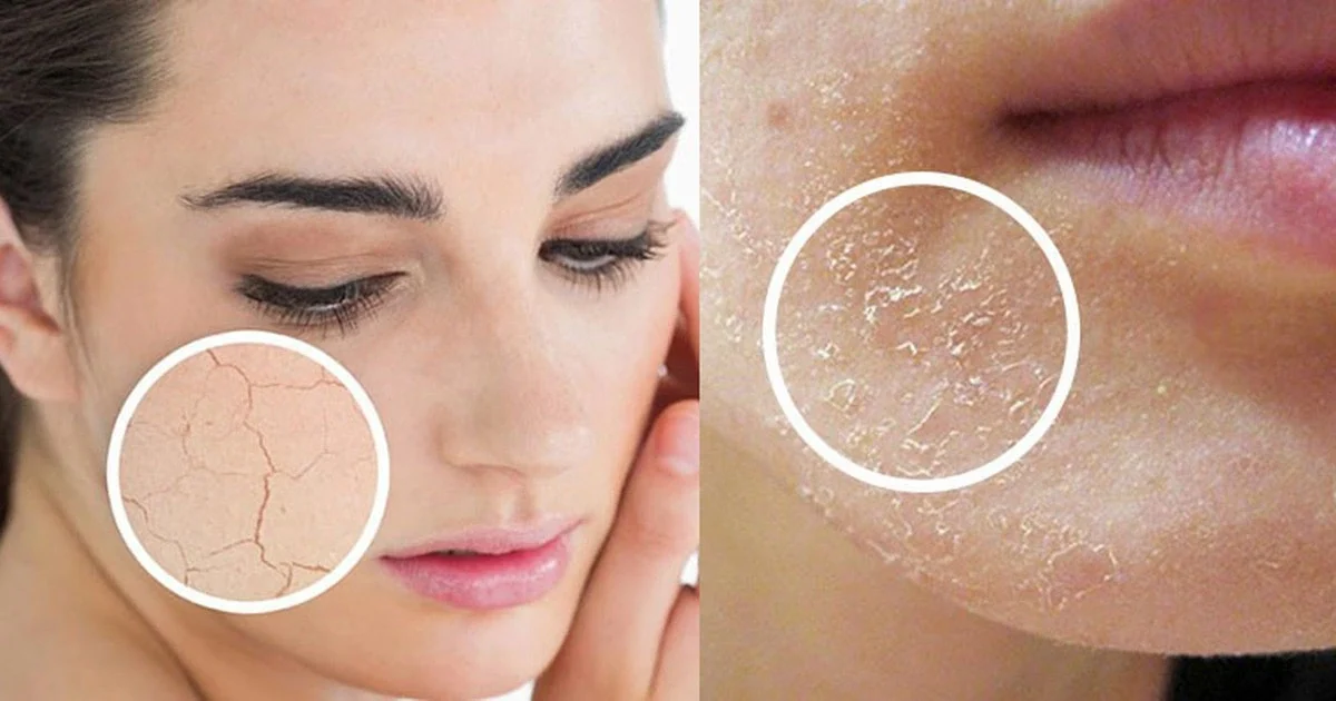 Hiểu rõ nguyên nhân để cải thiện da bị khô tróc vảy hiệu quả