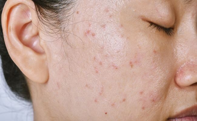 Da dầu mụn nên uống gì? Một số loại thức uống cải thiện da dầu mụn từ bên trong