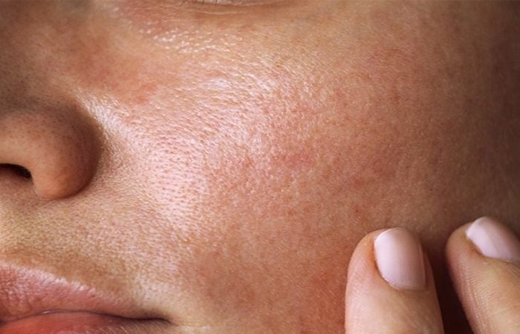 Da Dầu Nhạy Cảm: Những Điều Cần Biết Để Chăm Sóc Hiệu Quả