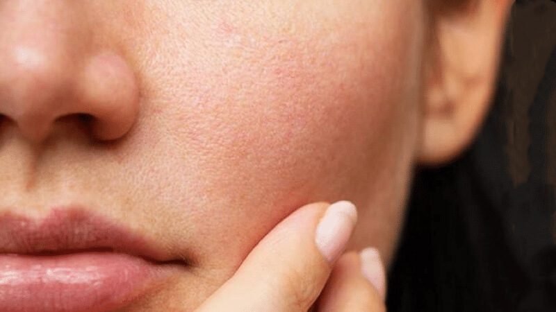 Nhận biết đặc điểm của da mặt bị nhạy cảm