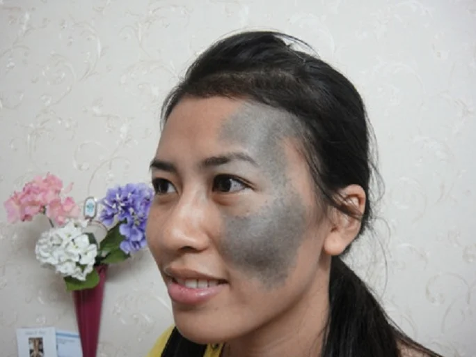 Những lưu ý khi điều trị chàm bằng laser toning