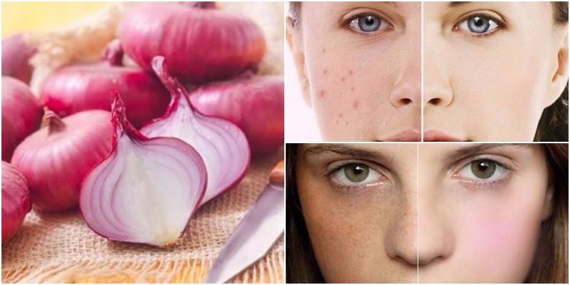 Tại sao hành tây tím giúp giảm mụn