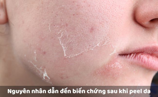 Nguyên nhân dẫn đến hiện tượng sau khi peel da