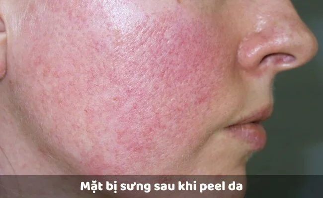 Sưng đỏ là một hiện tượng sau peel da