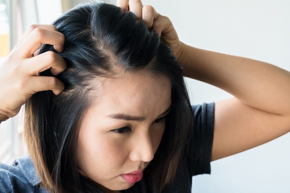 Liệu pháp miễn dịch tiếp xúc trị rụng tóc từng vùng là gì