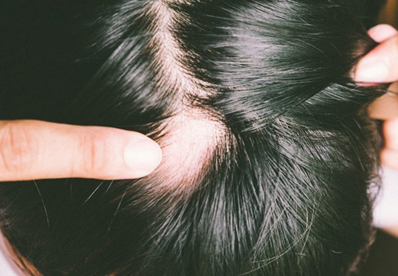 Lưu ý và tác dụng phụ khi áp dụng liệu pháp miễn dịch tiếp xúc