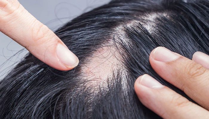Bạn thắc mắc gì về liệu pháp miễn dịch tiếp xúc trong điều trị rụng tóc từng vùng hay cần tư vấn cá nhân. Vui lòng liên hệ được được tư vấn thêm