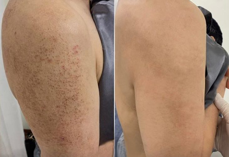 Những thắc mắc về chăm sóc lỗ chân lông to ở tay
