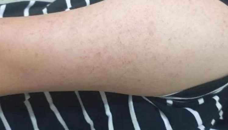 Tìm hiểu nguyên nhân lỗ chân lông to ở tay