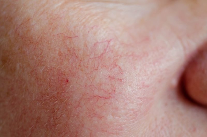 Ảnh hưởng của mao mạch lên làn da và tiến trình lão hóa