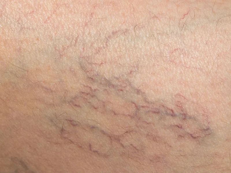 Cải thiện da giãn mao mạch với sản phẩm chăm sóc da phù hợp