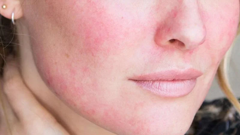 Tại sao nên dùng mẹo dân gian chữa mẩn đỏ da nhạy cảm