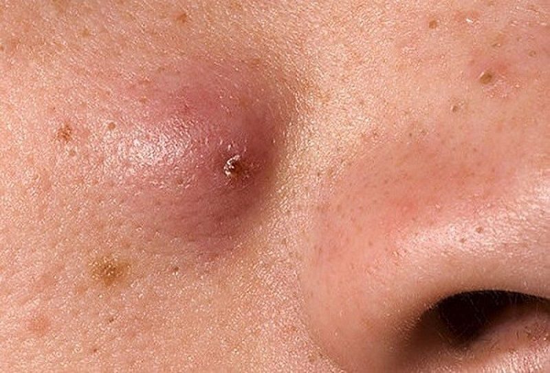 Mụn đầu đinh là gì? Mụn đầu đinh có nguy hiểm không?