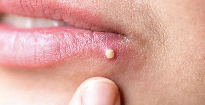 Cách xử lý mụn đầu đinh đúng cách
