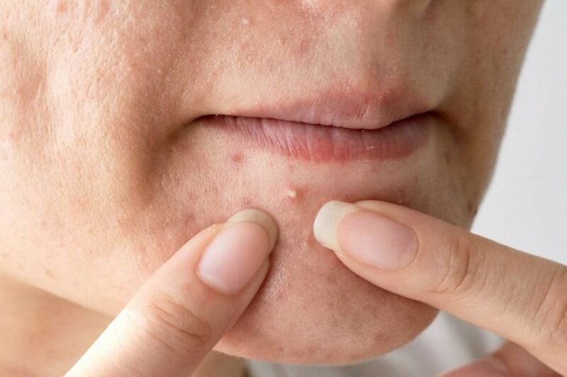 Các phương pháp điều trị mụn đầu trắng hiệu quả