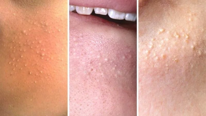 Mụn đầu trắng là gì? Tìm hiểu nguyên nhân gây mụn đầu trắng