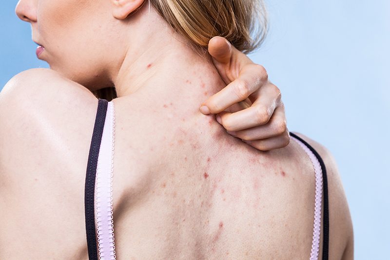 Tìm hiểu nguyên nhân mụn lưng do đâu