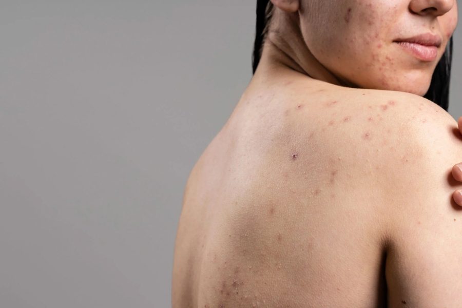 Một số phương pháp tự nhiên hỗ trợ điều trị mụn lưng tại nhà