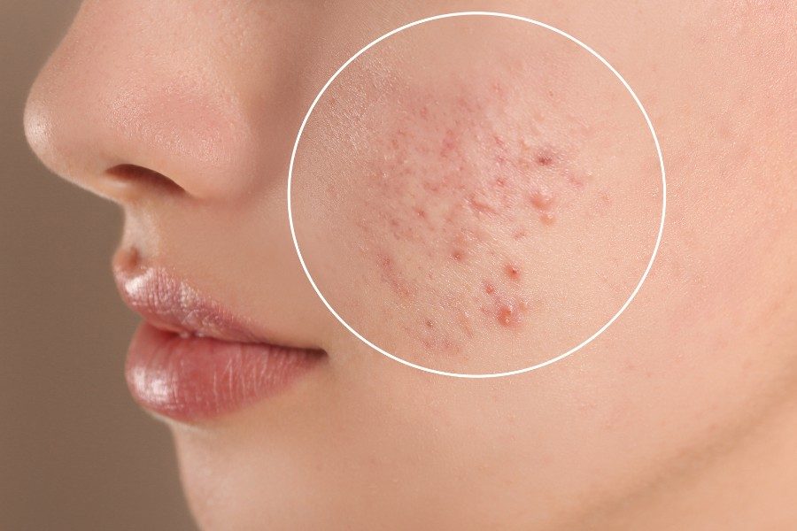 Tìm hiểu nguyên nhân mụn trứng cá do stress