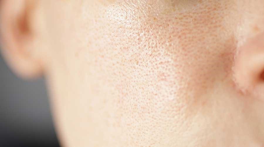 Hiểu rõ nguyên nhân để biết cách chọn mỹ phẩm đặc trị lỗ chân lông to