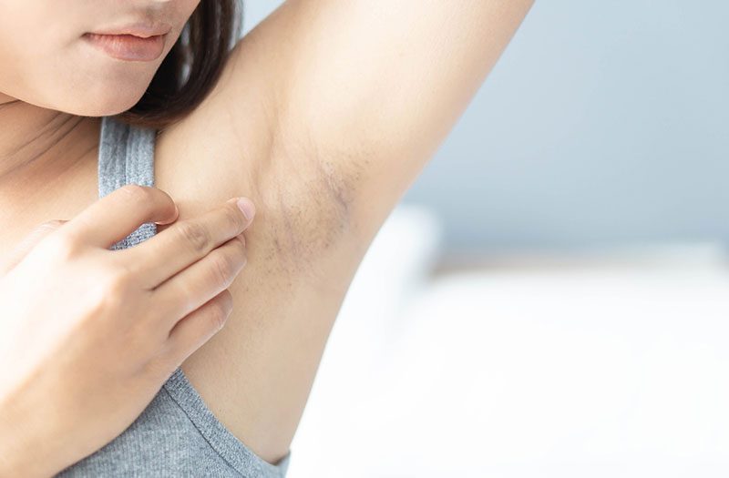 Phương pháp chuyên sâu hỗ trợ cải thiện thâm nách tại nhà
