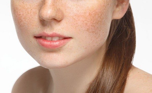 Nám nông là gì? Biện pháp phòng ngừa nám nông tái phát