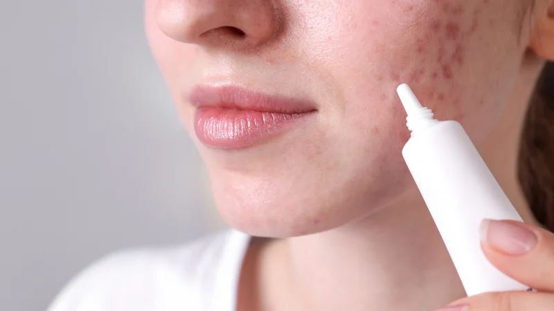 Nồng độ Tretinoin có mấy loại? Lựa chọn sao cho phù hợp với da