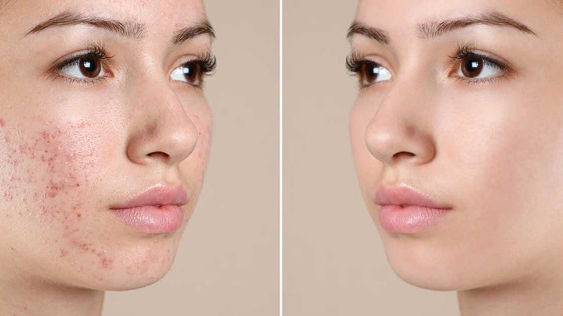 Peel da trị mụn là gì? Các loại peel da trị mụn phổ biến hiện nay