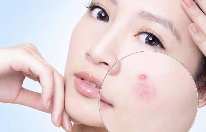 Nguyên tắc khi đưa Salicylic acid vào chu trình dưỡng da