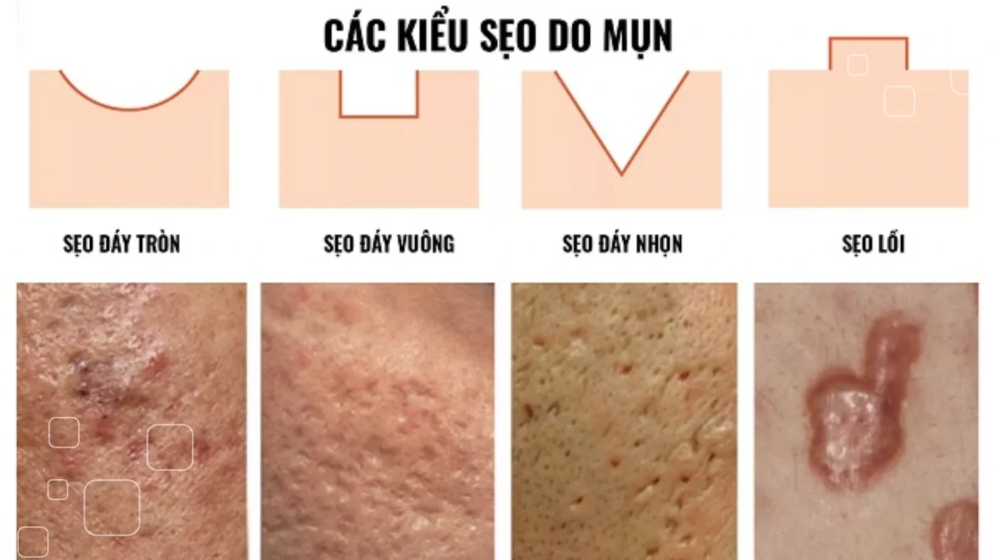 Sẹo mụn là gì? Tìm hiểu nguyên nhân và phân loại sẹo mụn