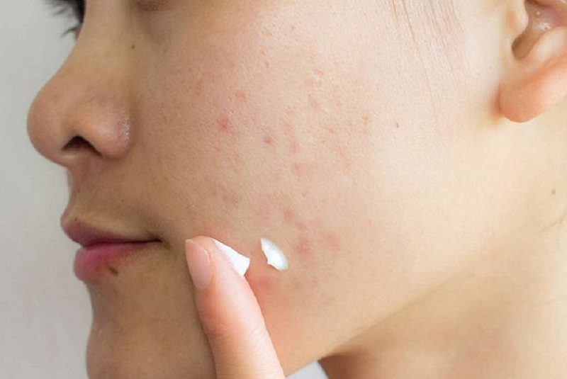 Lựa chọn phương án điều trị sẹo mụn phù hợp theo cơ địa