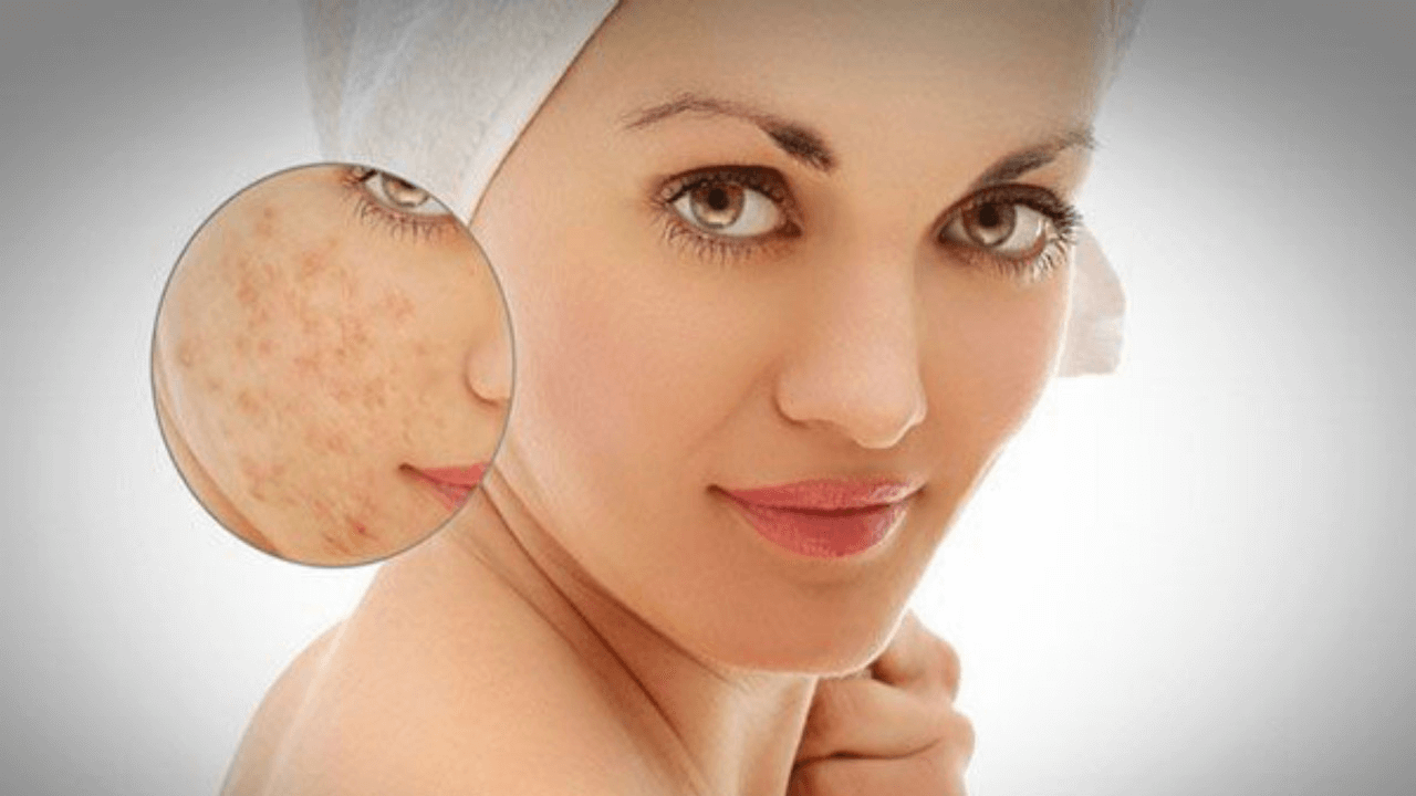 Lưu ý khi lựa chọn serum trị sẹo rỗ