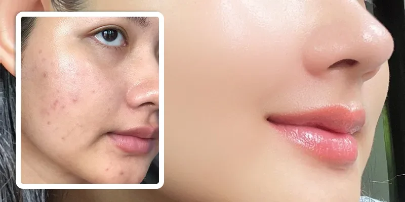 Tác dụng của meso extra không kim đối với làn da