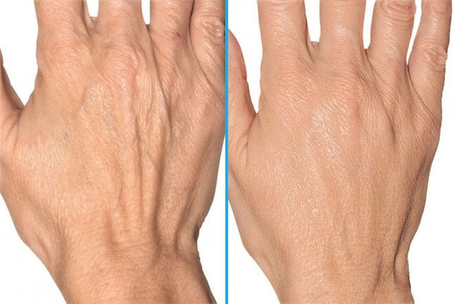 Tìm hiểu các phương pháp trẻ hóa bàn tay phổ biến hiện nay