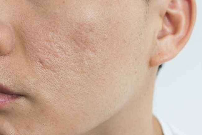 Tìm hiểu phương pháp trị lỗ chân lông to và sẹo rỗ phổ biến hiện nay