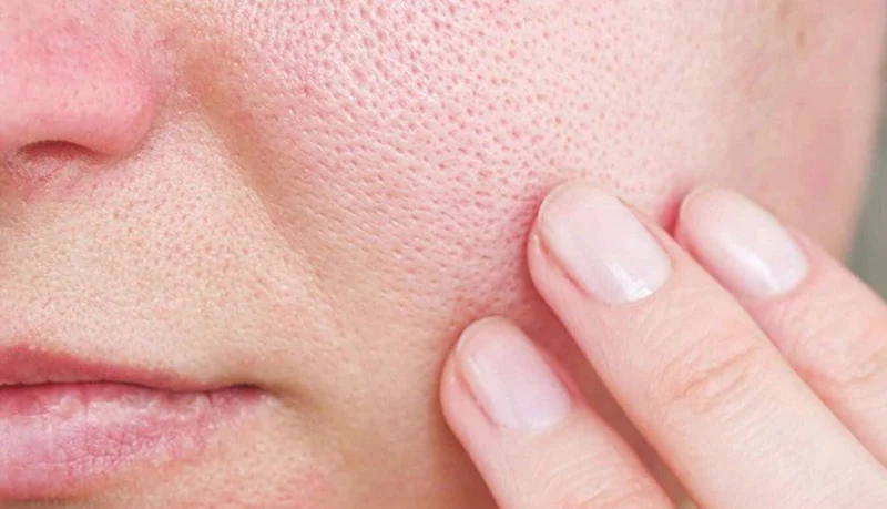 Những lưu ý khi trị lỗ chân lông to và sẹo rỗ