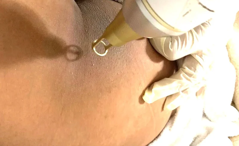 Mẹo tối đa chi phí trị thâm mông bằng laser giá bao nhiêu