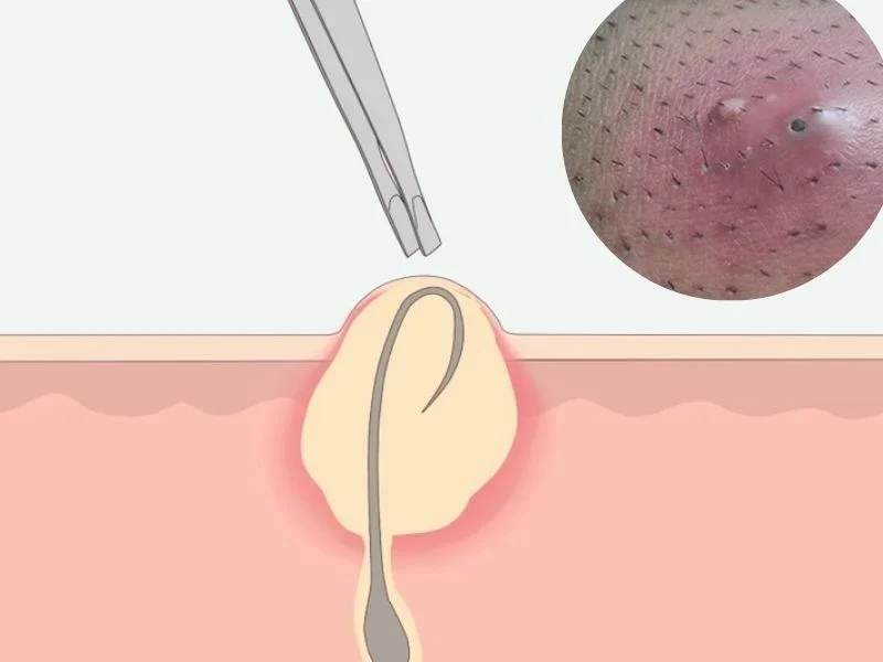 U nang lông là gì? Tìm hiểu cách phòng ngừa u nang lông tái phát