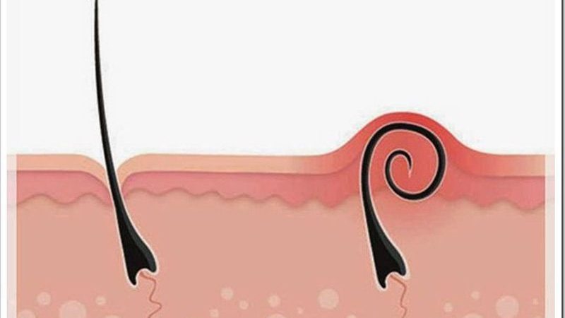 Sử dụng đúng sản phẩm sau điều trị u nang lông không chỉ giúp làn da phục hồi nhanh mà còn hạn chế tối đa tình trạng tái phát.