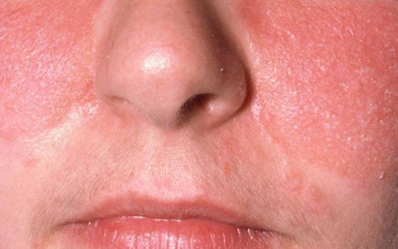 Phân biệt viêm da tiết bã với các bệnh lý da khác