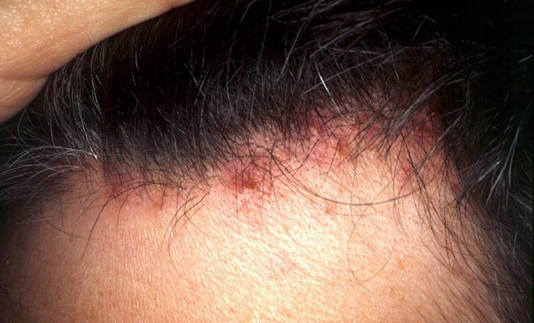 Viêm nang lông da đầu do đâu? Tìm hiểu nguyên nhân gây viêm nang lông da đầu
