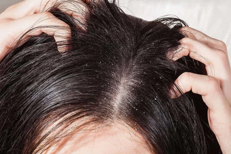 Tìm hiểu cách chuẩn đoán viêm nang lông da đầu do đâu và cách chăm sóc phù hợp