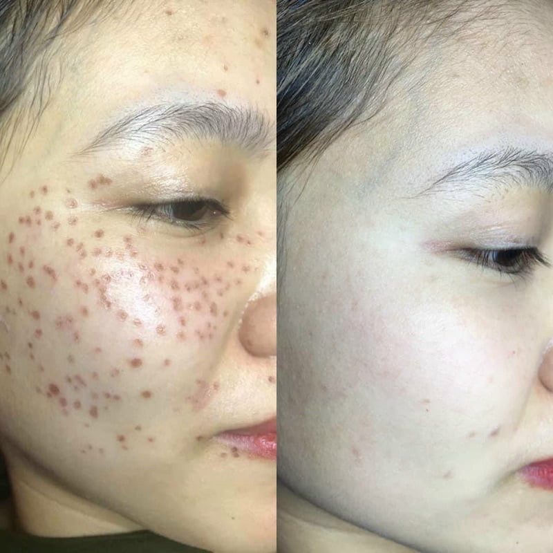 Hiệu quả sau khi bắn tàn nhang: Kết quả thực tế và yếu tố ảnh hưởng