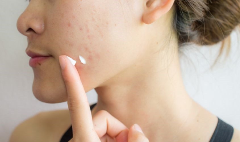 Cách sử dụng Benzoyl peroxide trị mụn viêm để đạt hiệu quả tối ưu