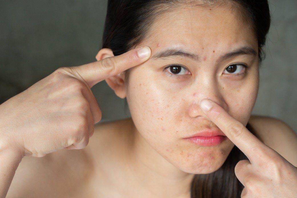 Chính nhờ các đặc tính này, Benzoyl peroxide trị mụn viêm trở thành một trong những hoạt chất “kinh điển” được bác sĩ da liễu tin tưởng khi xây dựng phác đồ điều trị mụn viêm.